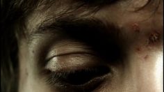 poster-14001-lg-acne-236x132