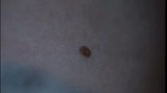 poster-20790-frank-net-cancer-236x132